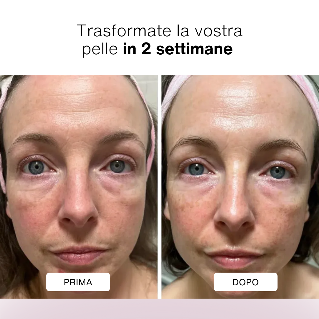 FACELIFT© - Dispositivo per la cura della pelle anti-età e occhiaie con luce rossa